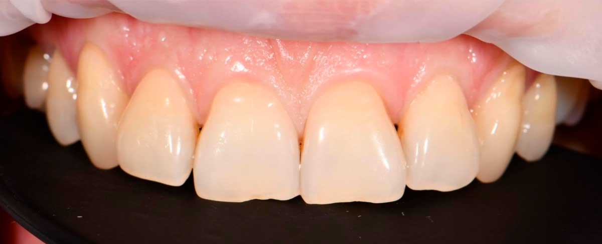 odnomomentnaya-implantaciya-posle1